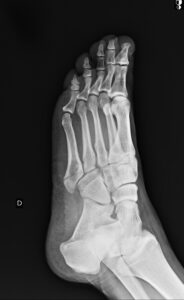 fratura da base do 5º metattarso